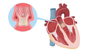 TRANSCATHETER AORTIC VALVE REPLACEMENT (TAVR)